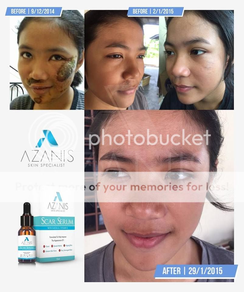 New Azanis Scar Serum Advance Formulation Vitamin E Premium Treatment ...